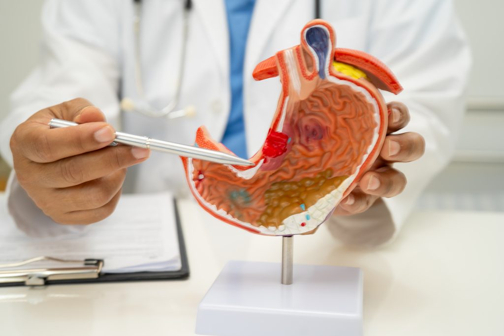pancreatic cancer